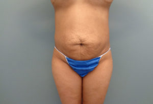 Abdominoplasty Before & After Pictures in Nashville, TN