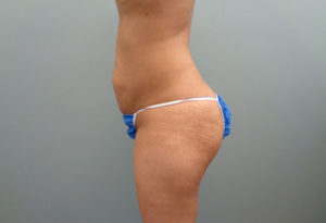 Abdominoplasty Before & After Pictures in Nashville, TN