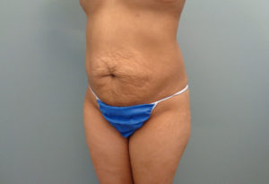 Abdominoplasty Before & After Pictures in Nashville, TN