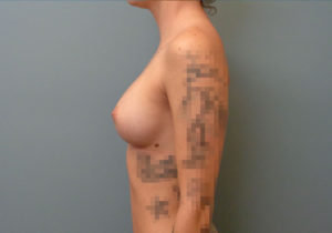 Breast augmentation Before & After Pictures in Nashville, TN