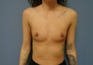 Breast augmentation Before & After Pictures in Nashville, TN