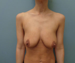 Breast augmentation with Lift Before & After Pictures in Nashville, TN