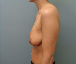 Breast augmentation with Lift Before & After Pictures in Nashville, TN