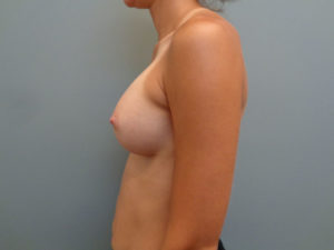 Breast Augmentation Before & After Pictures in Nashville, TN