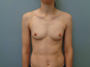 Breast Augmentation Before & After Pictures in Nashville, TN