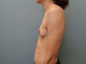 Breast Augmentation Before & After Pictures in Nashville, TN