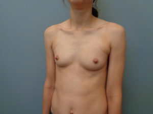 Breast Augmentation Before & After Pictures in Nashville, TN