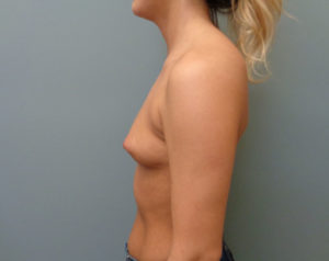 Breast Augmentation Before & After Pictures in Nashville, TN