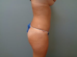 Abdominoplasty Before & After Pictures in Nashville, TN