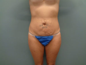 Abdominoplasty Before & After Pictures in Nashville, TN