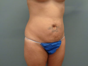 Abdominoplasty Before & After Pictures in Nashville, TN