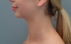 Chin augmentation Before & After Pictures in Nashville, TN