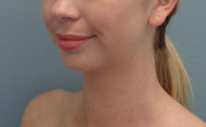 Chin augmentation Before & After Pictures in Nashville, TN