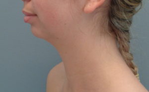 Chin augmentation Before & After Pictures in Nashville, TN