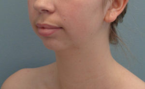 Chin augmentation Before & After Pictures in Nashville, TN