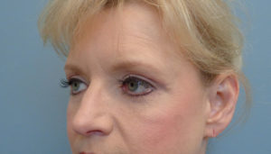 Blepharoplasty Before & After Pictures in Nashville, TN