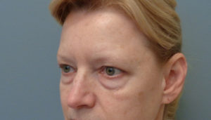 Blepharoplasty Before & After Pictures in Nashville, TN