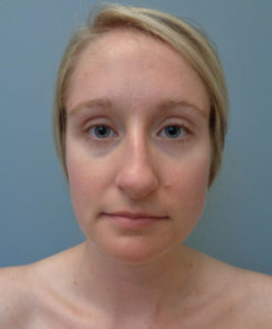 Rhinoplasty Before & After Pictures in Nashville, TN