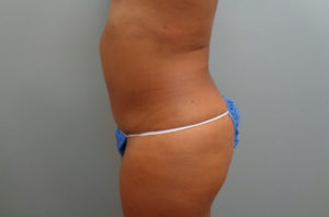 Abdominoplasty Before & After Pictures in Nashville, TN