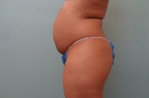 Abdominoplasty Before & After Pictures in Nashville, TN