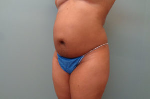 Abdominoplasty Before & After Pictures in Nashville, TN