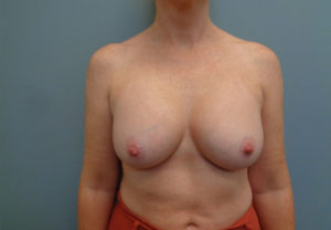 Breast Augmentation Before & After Pictures in Nashville, TN