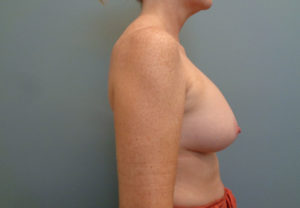 Breast Augmentation Before & After Pictures in Nashville, TN