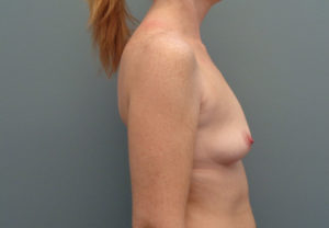 Breast Augmentation Before & After Pictures in Nashville, TN