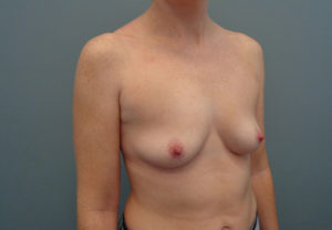 Breast Augmentation Before & After Pictures in Nashville, TN