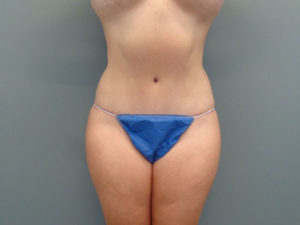 Abdominoplasty Before & After Pictures in Nashville, TN