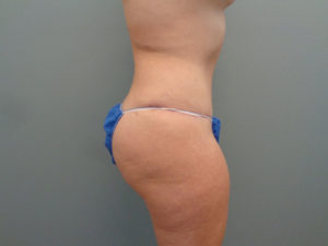 Abdominoplasty Before & After Pictures in Nashville, TN