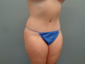 Abdominoplasty Before & After Pictures in Nashville, TN