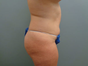 Abdominoplasty Before & After Pictures in Nashville, TN