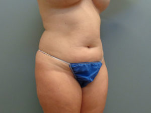 Abdominoplasty Before & After Pictures in Nashville, TN