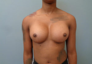 Breast Augmentation Before & After Pictures in Nashville, TN