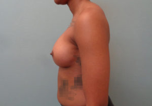 Breast Augmentation Before & After Pictures in Nashville, TN