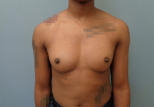 Breast Augmentation Before & After Pictures in Nashville, TN