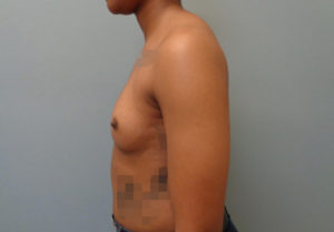 Breast Augmentation Before & After Pictures in Nashville, TN