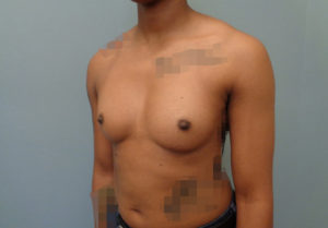 Breast Augmentation Before & After Pictures in Nashville, TN