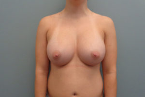 Breast Augmentation Before & After Pictures in Nashville, TN