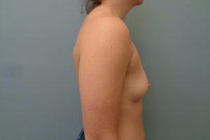 Breast Augmentation Before & After Pictures in Nashville, TN