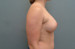 Breast Augmentation Before & After Pictures in Nashville, TN