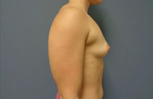 Breast Augmentation Before & After Pictures in Nashville, TN