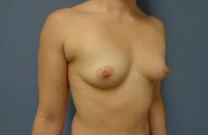 Breast Augmentation Before & After Pictures in Nashville, TN