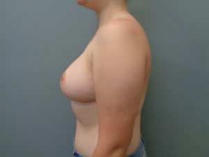 Breast Reduction Before & After Pictures in Nashville, TN