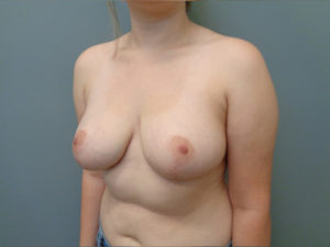 Breast Reduction Before & After Pictures in Nashville, TN