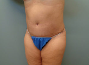 Abdominoplasty Before & After Pictures in Nashville, TN