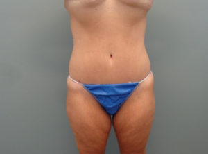 TUMMY TUCK BEFORE & AFTER PICTURES IN NASHVILLE, TN