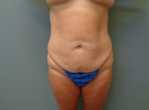 TUMMY TUCK BEFORE & AFTER PICTURES IN NASHVILLE, TN