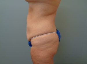 TUMMY TUCK BEFORE & AFTER PICTURES IN NASHVILLE, TN